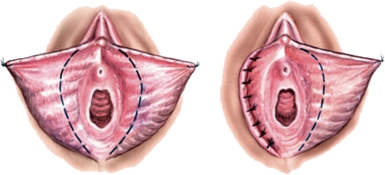 Adana Labioplasti Ameliyatı